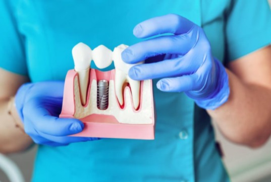 Имплантология и зъбни импланти в Благоевград